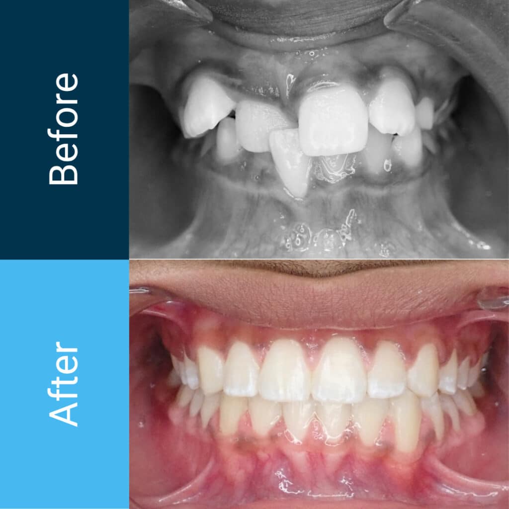 Front view before and after braces, with severely crowded upper teeth and an anterior crossbite resolved into a straight, healthy smile at Beam Orthodontics in Sugar Land, TX
